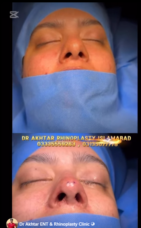 Dr Akhtar ENT and Rhinoplasty Clinic - Before and After Rhinoplasty