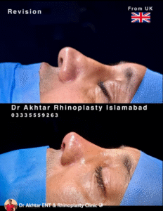 Home dr akhtar rhinoplasty