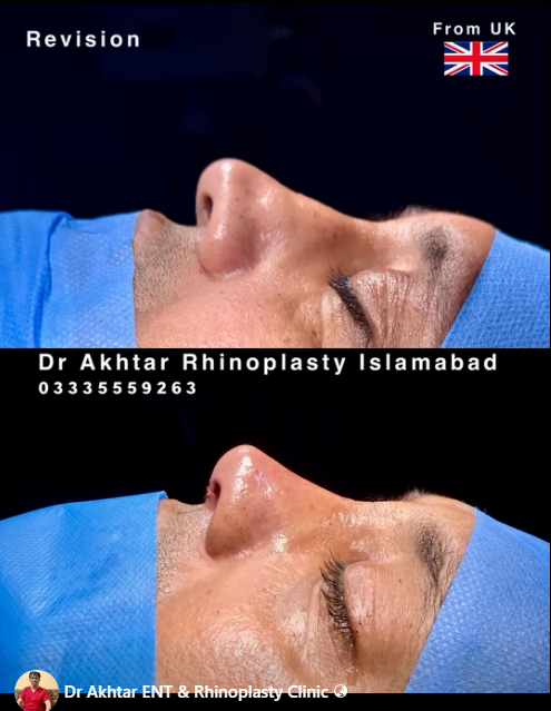 dr akhtar rhinoplasty