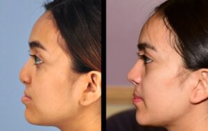 Home Dr Akhtar Rhinoplasty Hero Image