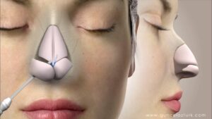 Home Befor and after Rhinoplasty with Dr Akthar Zaman