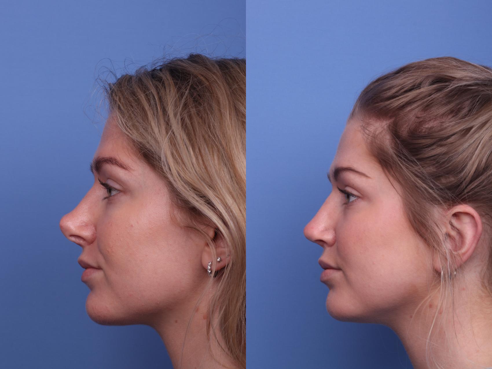 rhinoplasty revision 385 left side detail