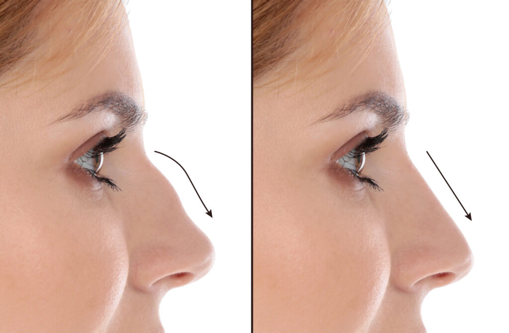 what rhinoplasty can do for you indy plastic 1024x670