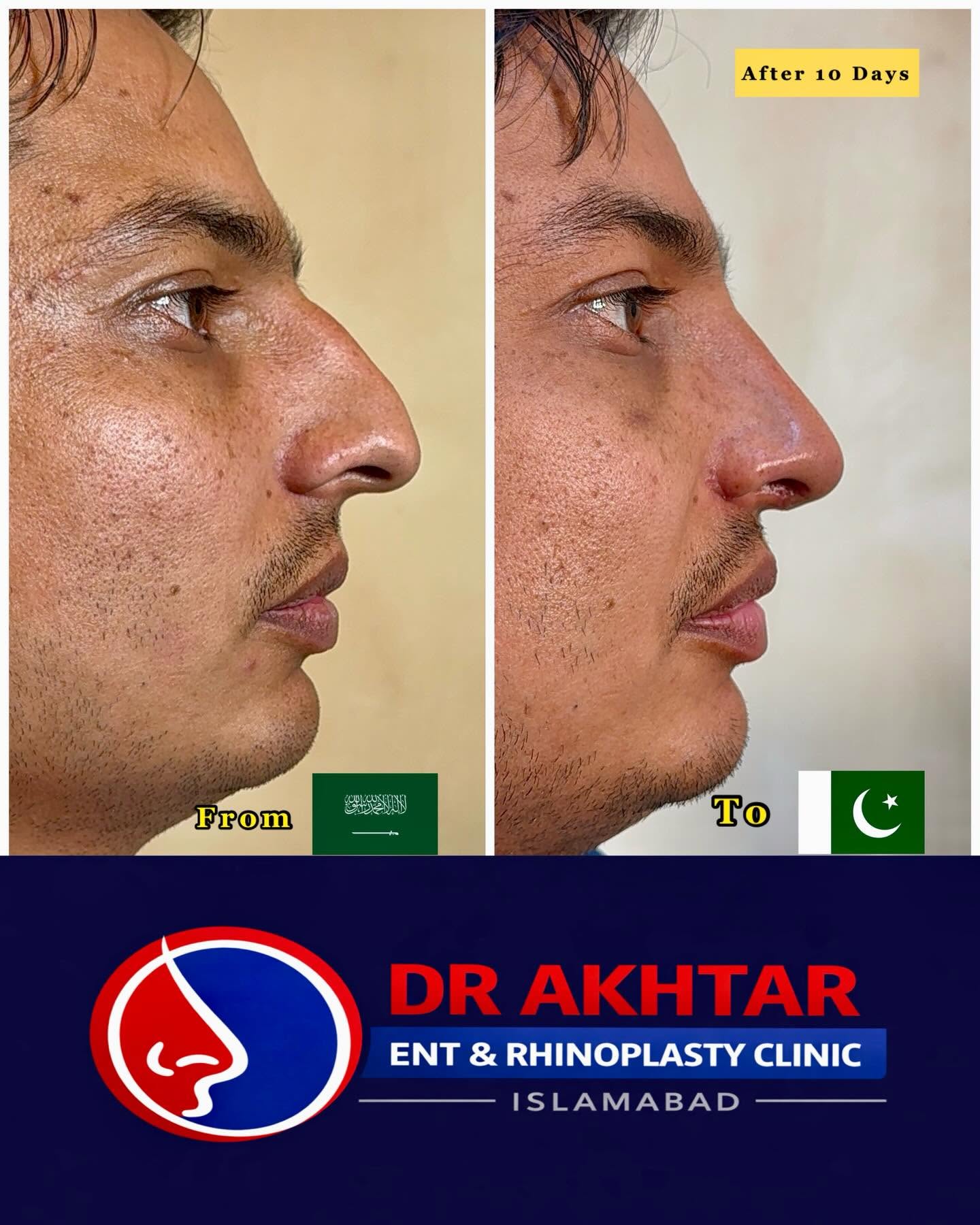 Rhinoplasty Recovery Tips rhinoplasty befor and after effects with dr akhtar zaman ent and rhinoplasty clinic g 8 markaz, islamabad