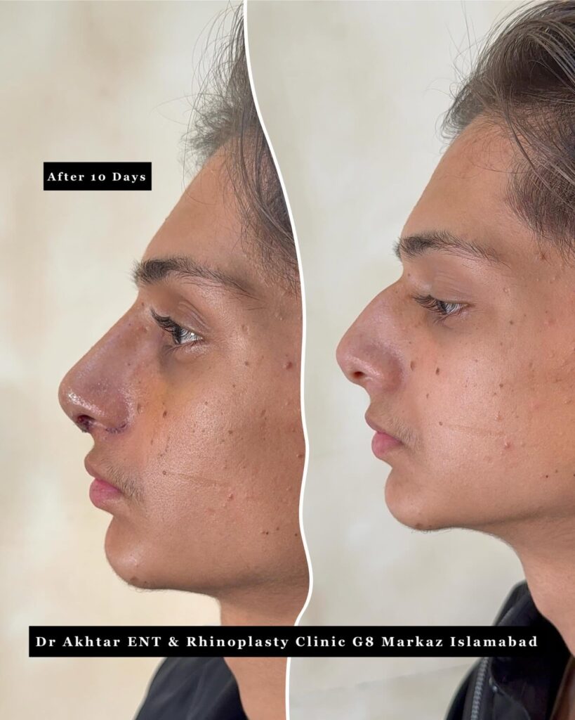 Revision Rhinoplasty in Islamabad before and after rhinoplasty with dr akhtar zaman ent and rhinoplasty clinic