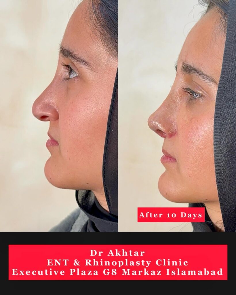 befor and after rhinoplasty with dr akthar ent and rhinoplasty clinic