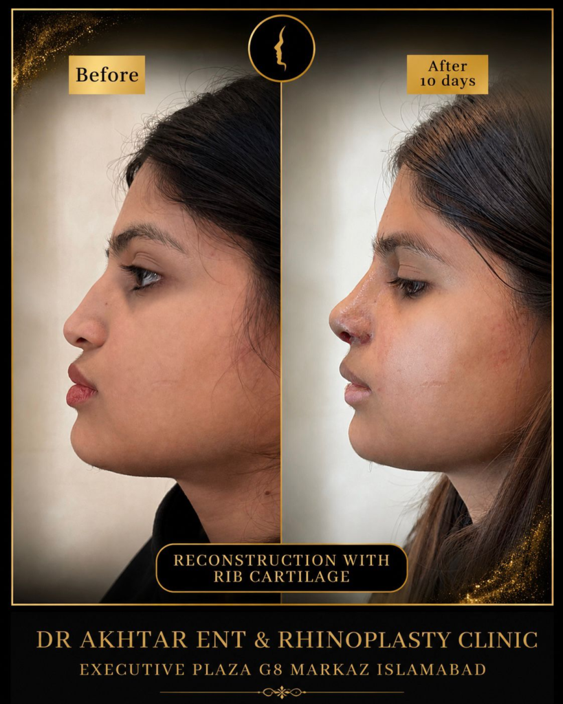 Benefist of Rhinoplasty