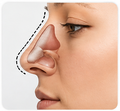 Rhinoplasty image for Dr Akhtar ENT and Rhinoplasty Clinic G 8 Markaz Service page 3