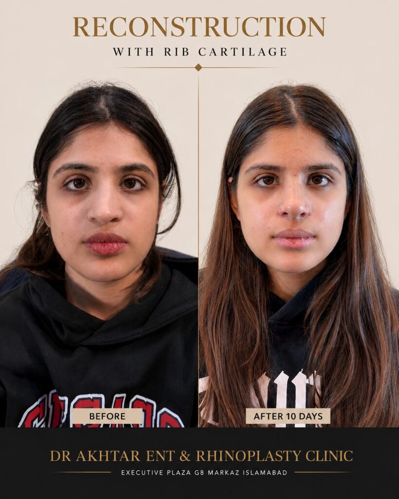 Revison rhinoplasty in Islambabad, Nose reshapping picture
