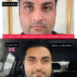dr akthar ent and rhinoplasty clinic nose plastic surgery rhinoplasty in Islamabad 2
