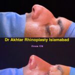 dr akthar ent and rhinoplasty clinic nose plastic surgery rhinoplasty in Islamabad 3