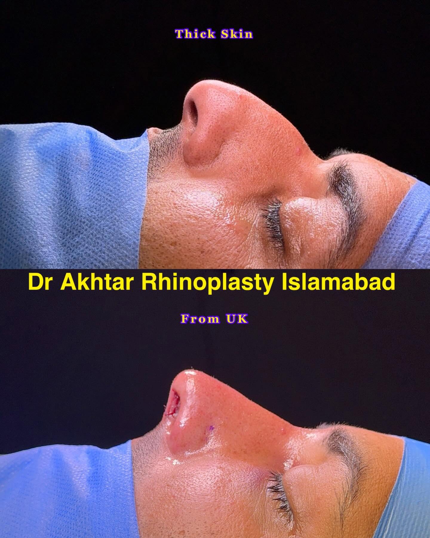 dr akthar ent and rhinoplasty clinic nose plastic surgery rhinoplasty in Islamabad 3