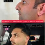 dr akthar ent and rhinoplasty clinic nose plastic surgery rhinoplasty in Islamabad 3