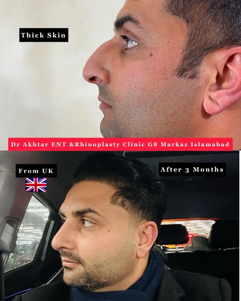 Deviated Septum and Rhinoplasty: Can Nose Surgery Improve Breathing and Appearance? Deviated septum and septorhinoplasty treatment in Islamabad